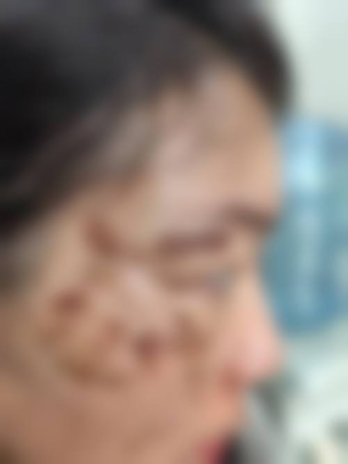 何秀治疗顽固性斑实例