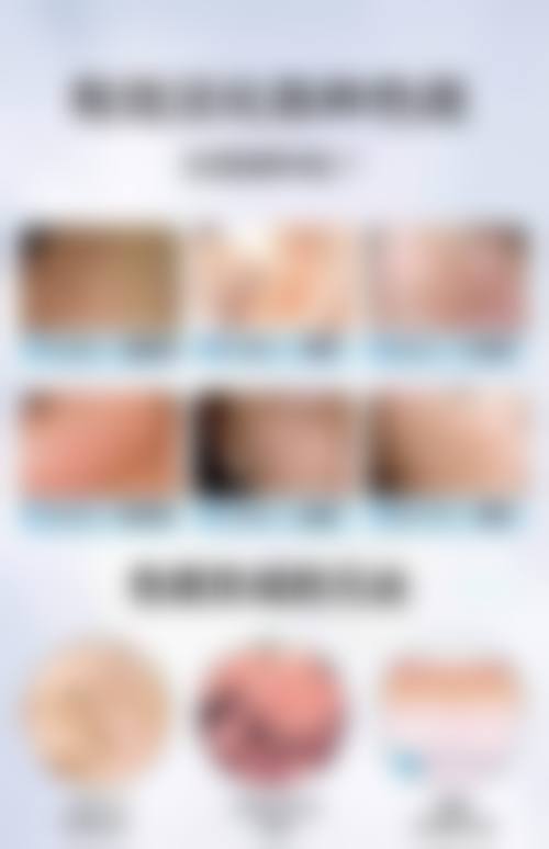 曹长源治疗白癜风实例