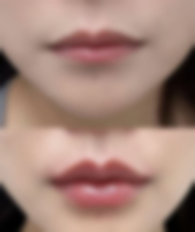 怎样巧妙改善疤痕疙瘩?药物治疗不可少