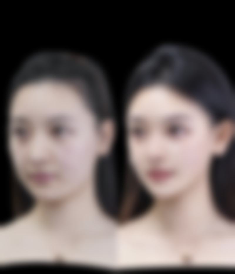 如何巧妙淡化双眼皮疤痕?风险提示和注意事项要牢记