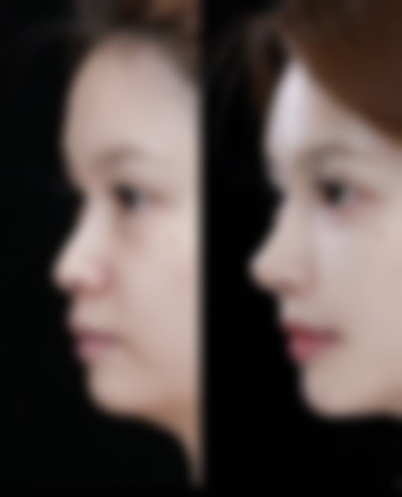 瘦脸针必知注意点：术前评估适配性、选合规药，术后精细护理保效果 