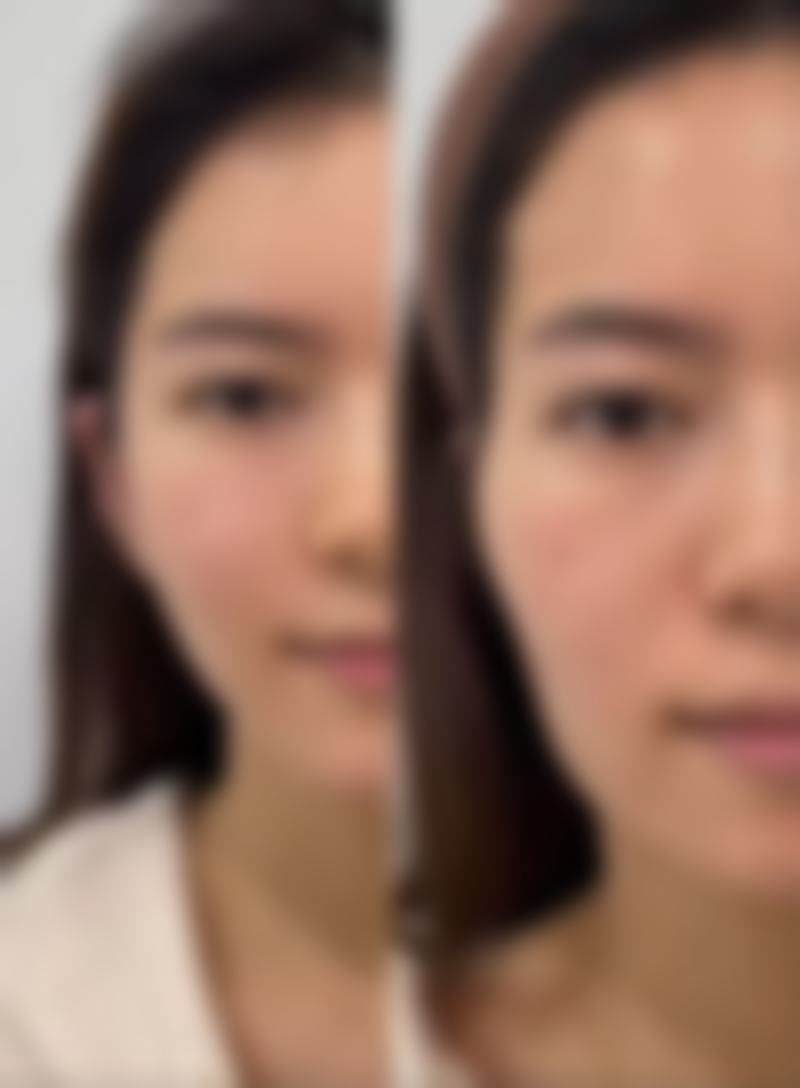 杨宏洲面部轮廓整形实例