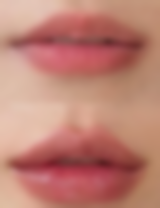 揭秘去眼袋的副作用：术后肿胀淤青、形态异常等问题，正规医院可降低风险 