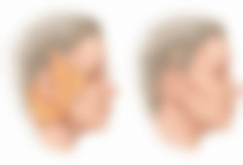 韩国本沐整形医院，切开法修复的靠谱之选