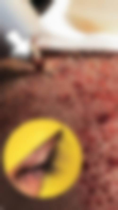 金铮治疗白癜风实例