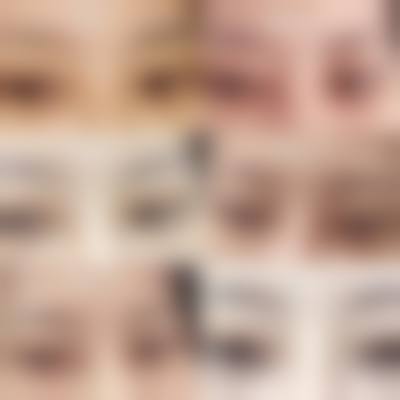 王文科眼部整形实例