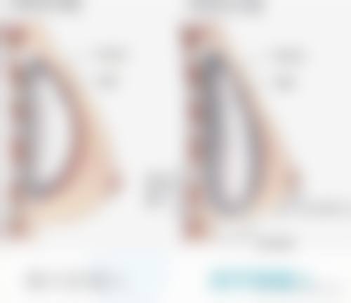 李键昊假体隆胸实例