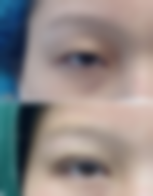 付崇华面部整形手术实例