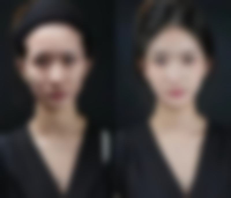 吸脂肪究竟是怎么操作的？传统、超声、水动力等多种吸脂方法各显神通 