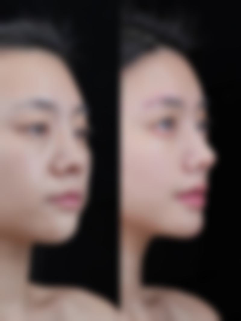 吸脂肪手术后要注意啥？