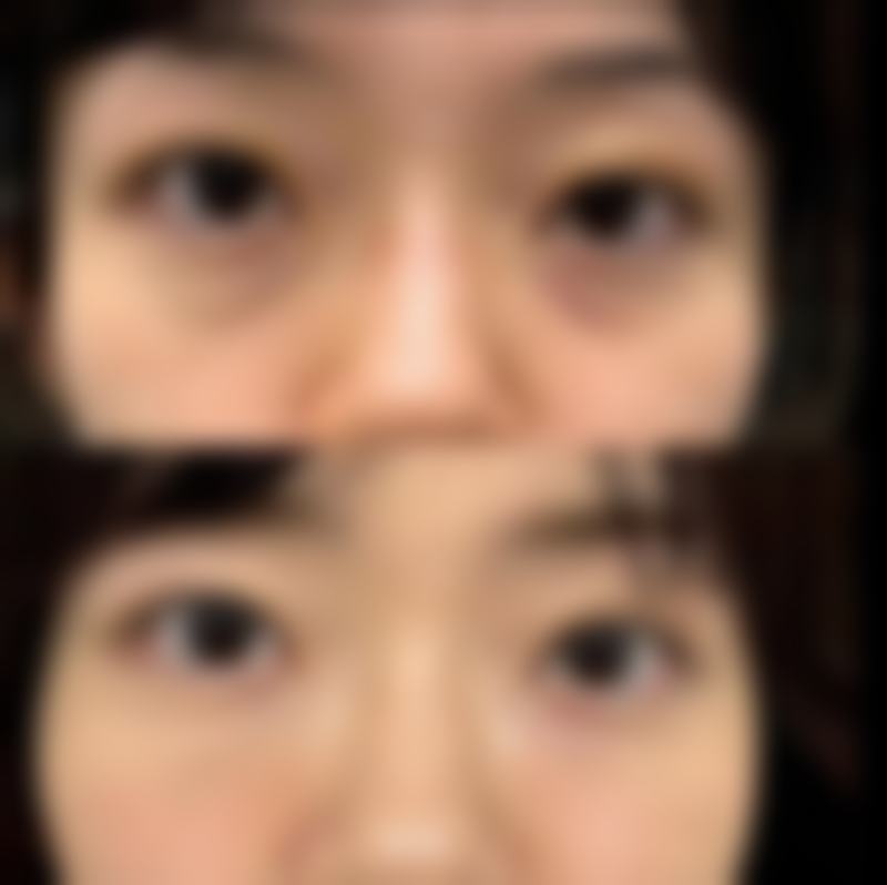 色素疤痕理想祛除之生活调整与坚持