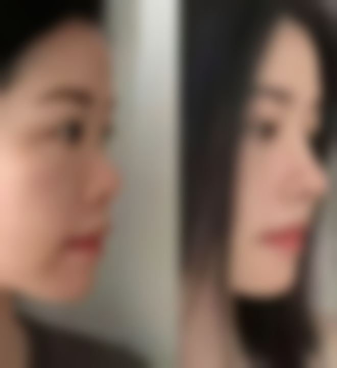 头发种植成效能维持多久？多种因素决定