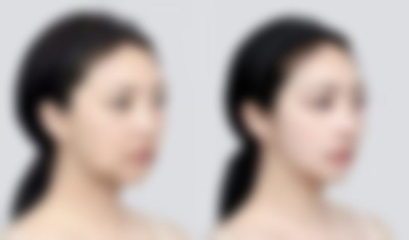 疤痕疙瘩不知咋改善？保持信心特别重要