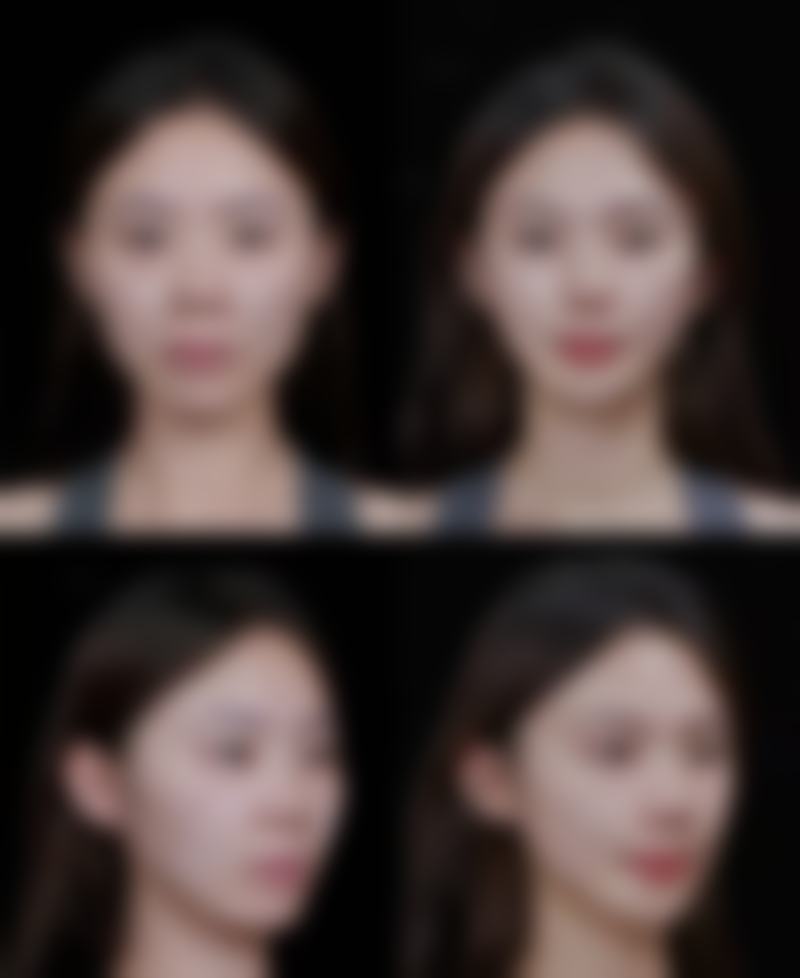 头发种植安不安心？微创技术有保护