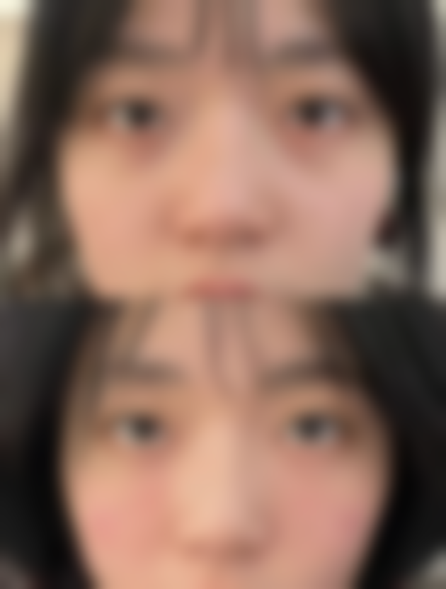 埋线双眼皮后常睁大眼睛，利于形成流畅线条吗？