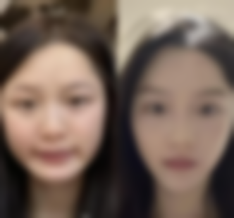 疤痕修复不理想咋办