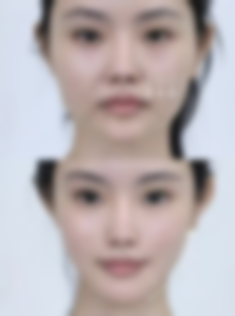 色素疤痕理想祛除之药物治疗显神通