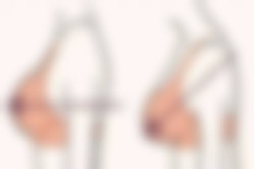 王嘉勋隆胸实例