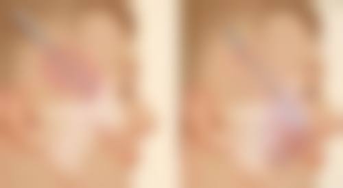 怎样让自体脂肪隆胸成效更好？清楚手术步骤特别关键