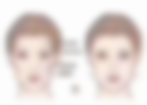 美杜莎与Park双眼皮哪个更适合你？对比手术缝合精细度