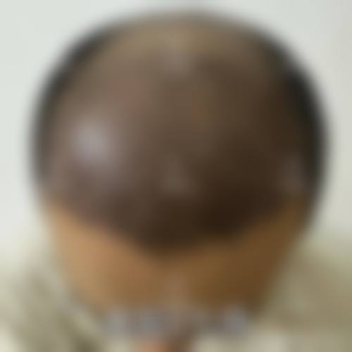 曹长源治疗白癜风实例