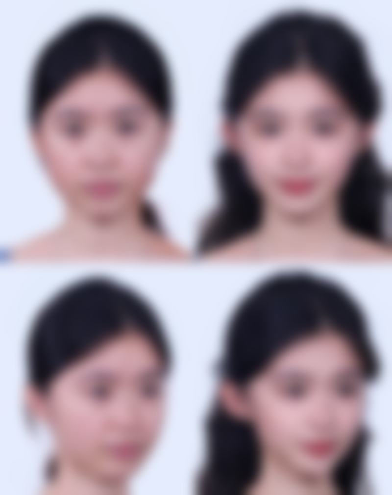 六、韩国半岛眼整形外科医院价格表：（仅供参考）