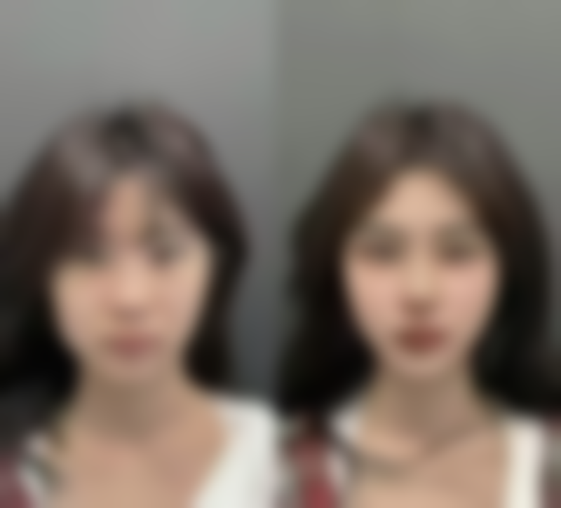 怎样让自体脂肪隆胸成效更好？选对适应人群特别重要