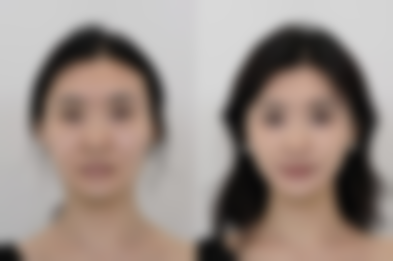 脚上抠的疤痕去除小贴士：治疗期间的注意事项