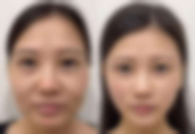 大腿抽脂究竟能瘦多少厘米？抽脂手术的优势展现