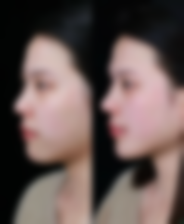 眼袋的成因与科学改善方式