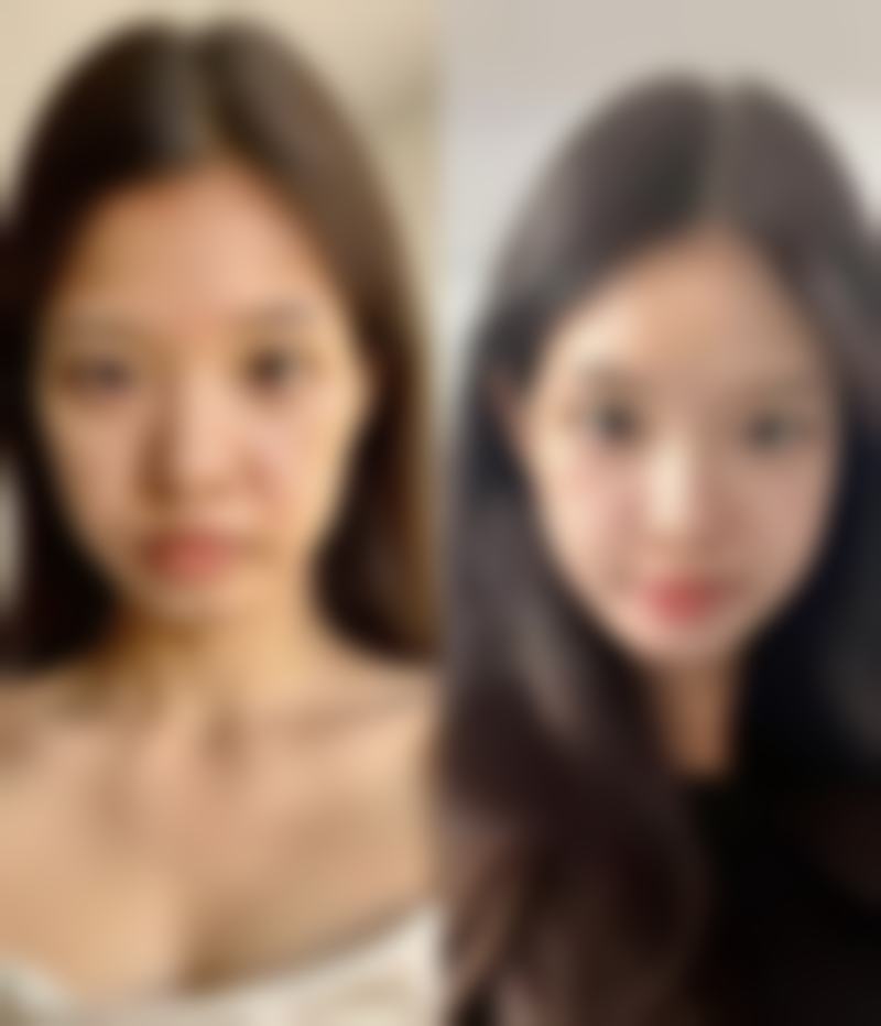 眼角下垂能否做双眼皮？解析不同程度下垂改善效果、术式及正规医院选择要点 