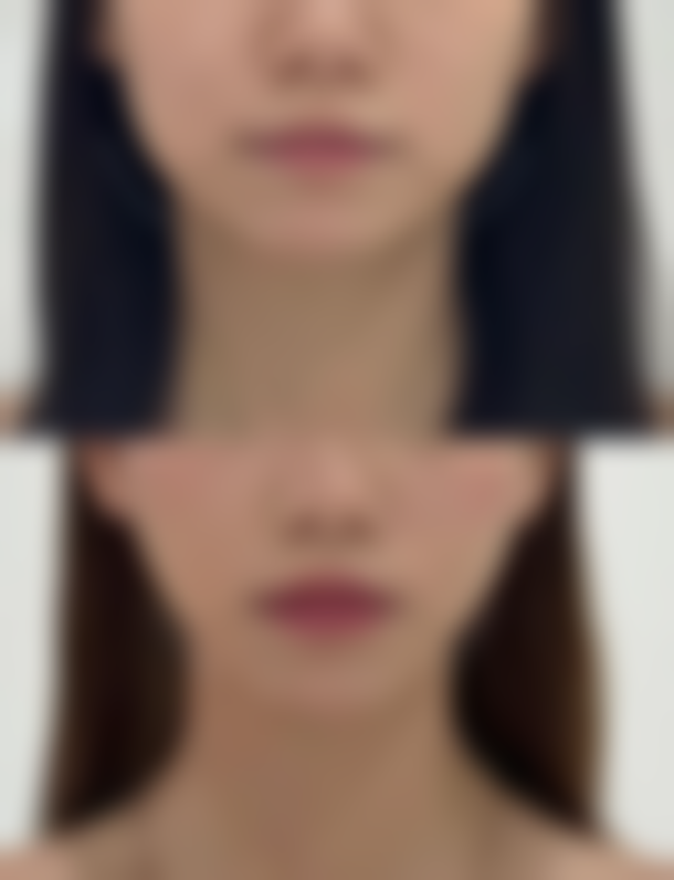 如何告别痘坑疤痕？个性化治疗方案来帮忙