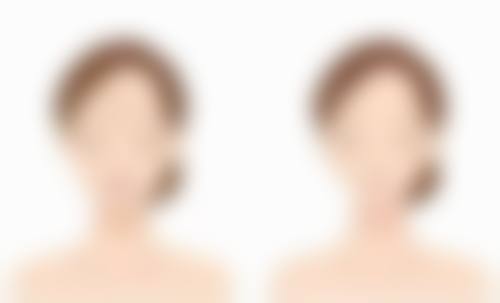 臀部吸脂减肥疼感可把控！术中麻醉术后护理助力，3月塑造理想臀型