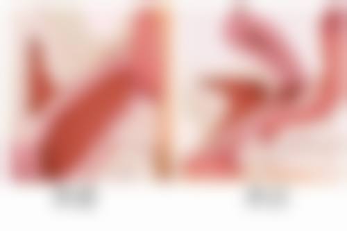 快速攻克疤痕疙瘩难题！多样治疗方案选择