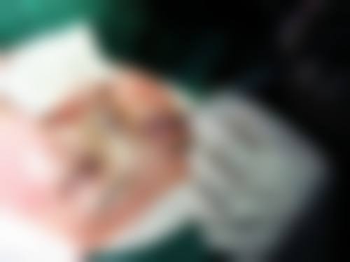 王见平双眼皮手术实例