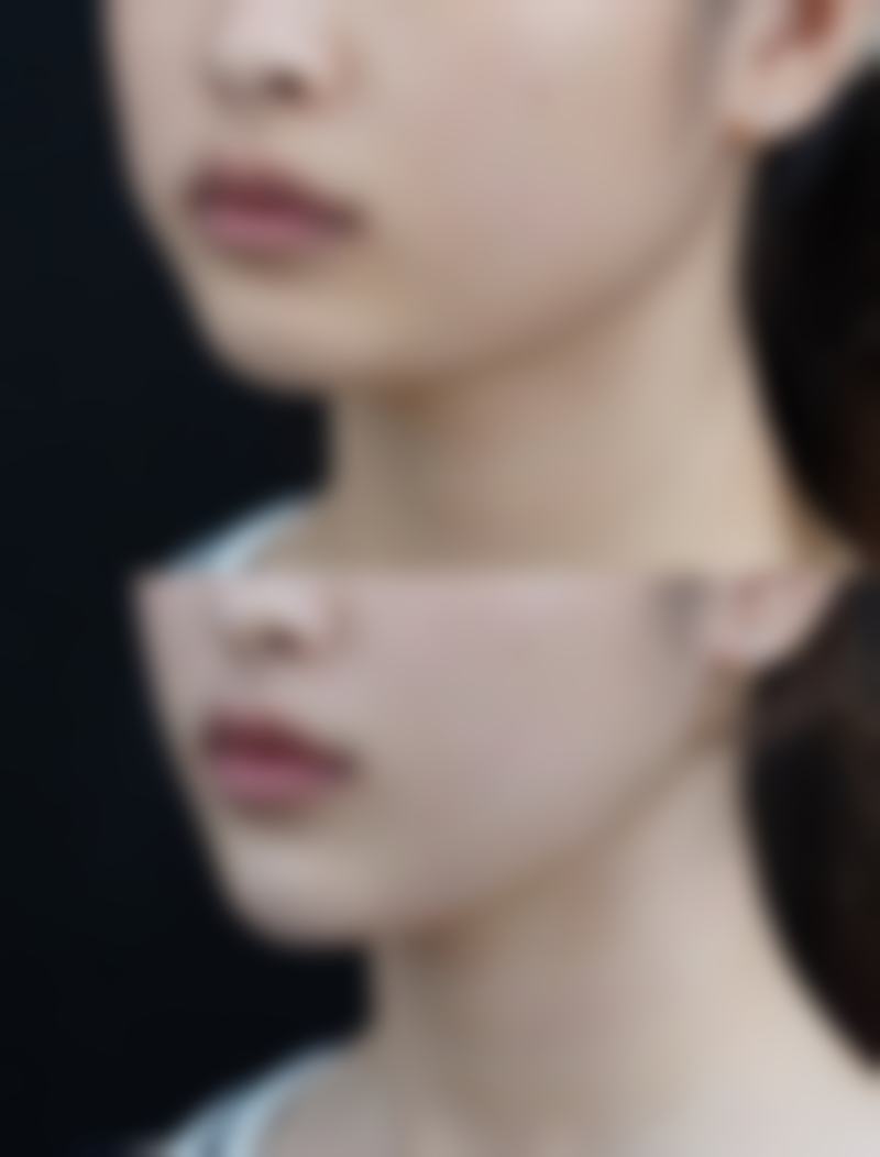 臀部吸脂减肥:适合人群与美观成效