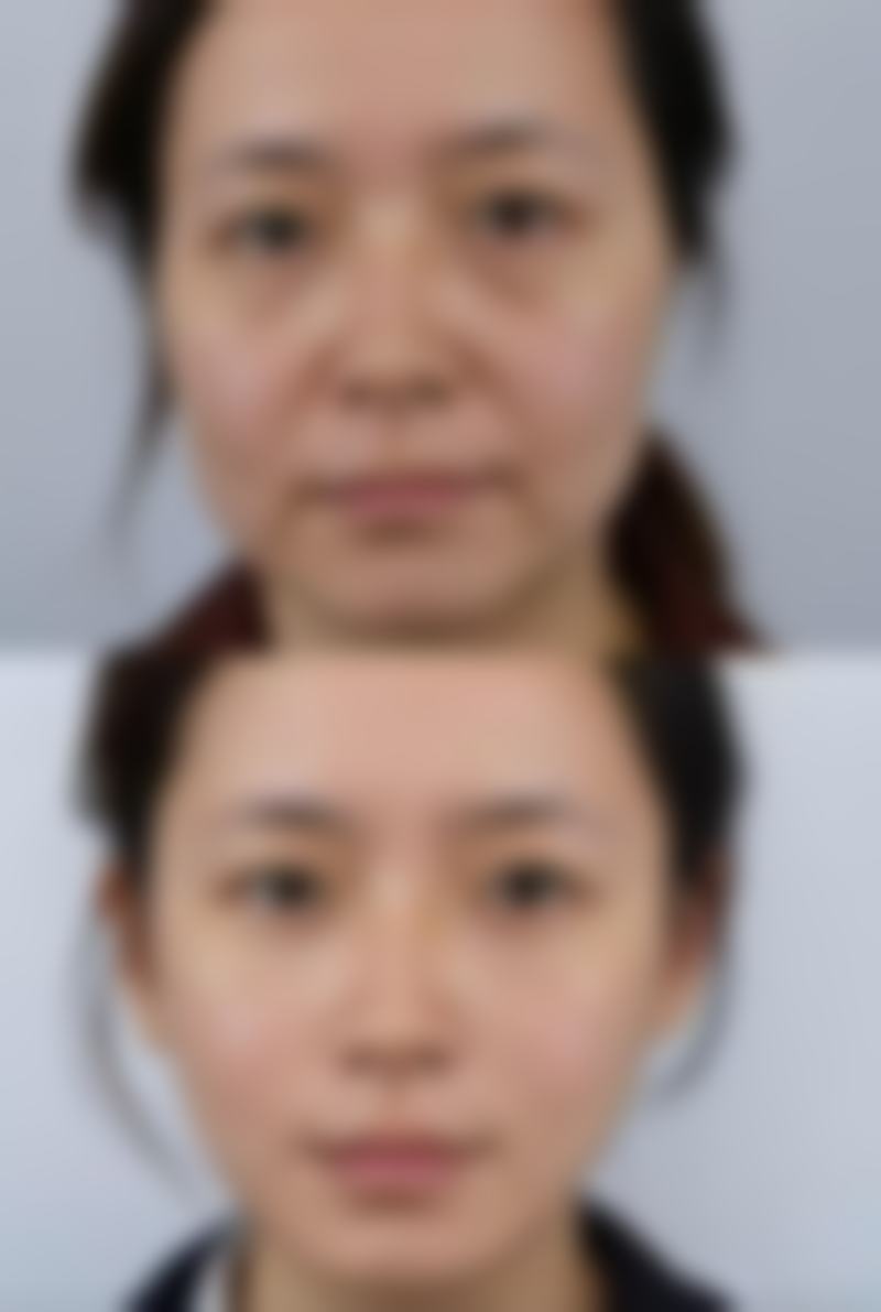 圆脸人打瘦脸针效果究竟多明显？揭秘咬肌型圆脸注射后下颌轮廓柔和变化秘诀