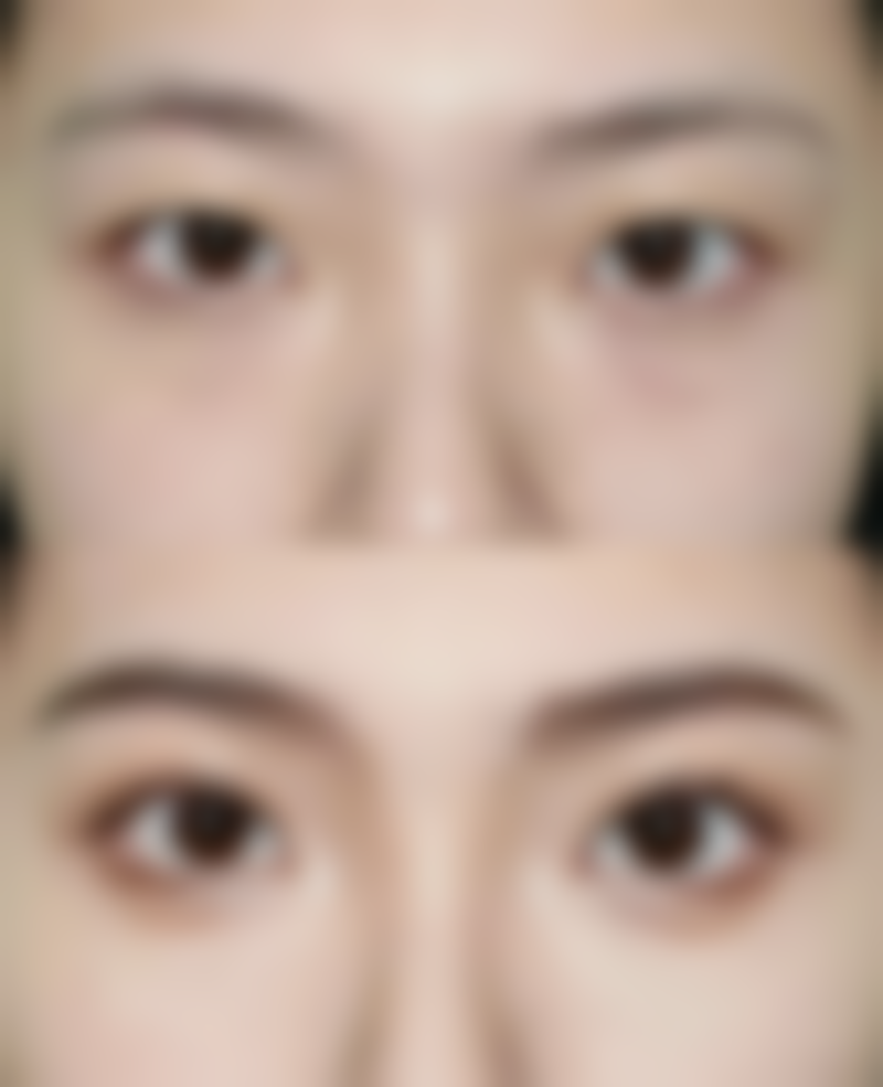 深度眼袋去除攻略大揭秘:手术治疗显神通