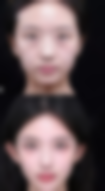 自体脂肪与假体隆胸：修复周期大比拼