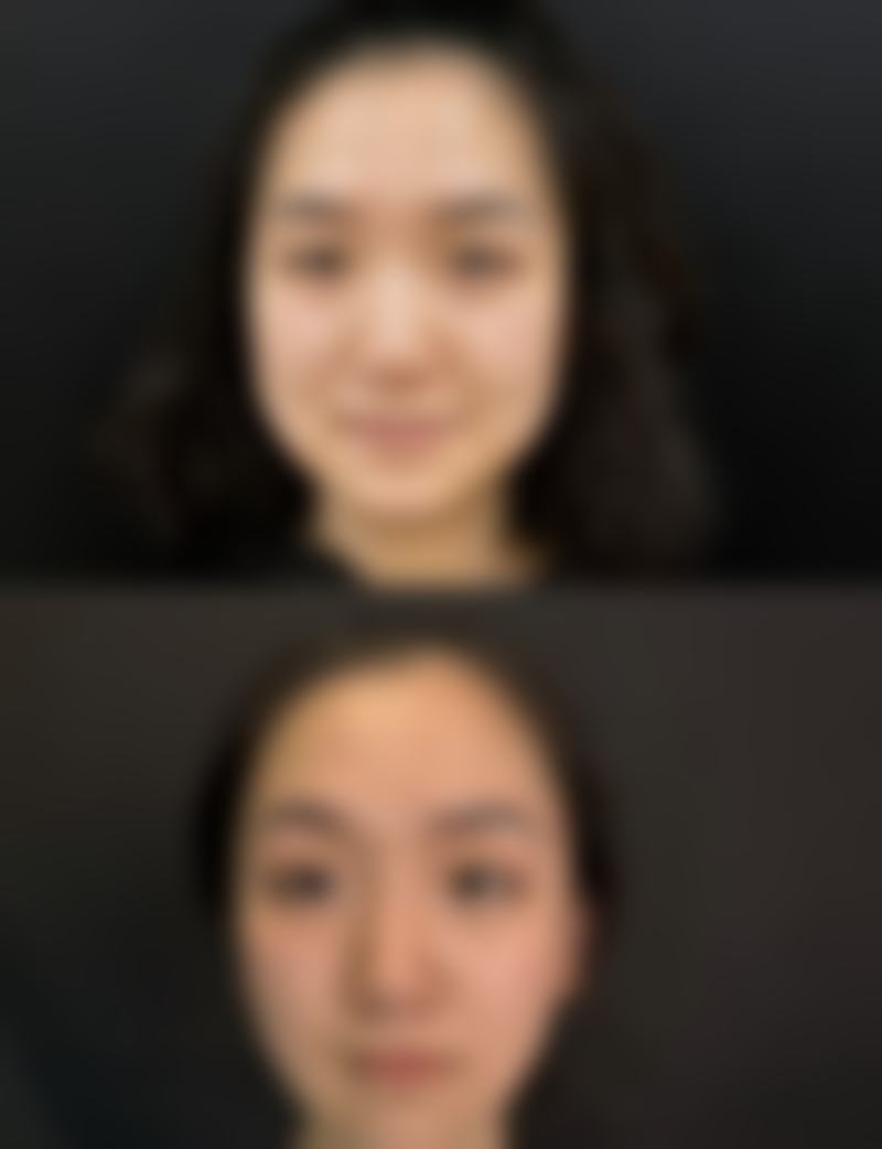 做完双眼皮肿成“悲伤蛙”？饮食调理，助力消肿修复