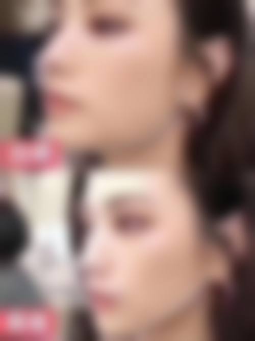 徐源弘双眼皮实例