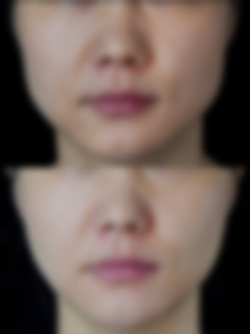 双眼皮窄了怎么修复？多种方案重塑自然宽度，恢复快且效果佳 