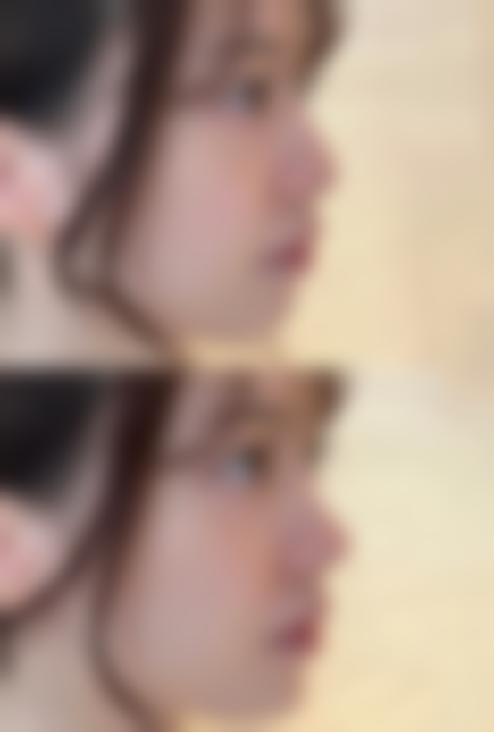 甲状腺手术后疤痕增生不愁!治疗成效看得见