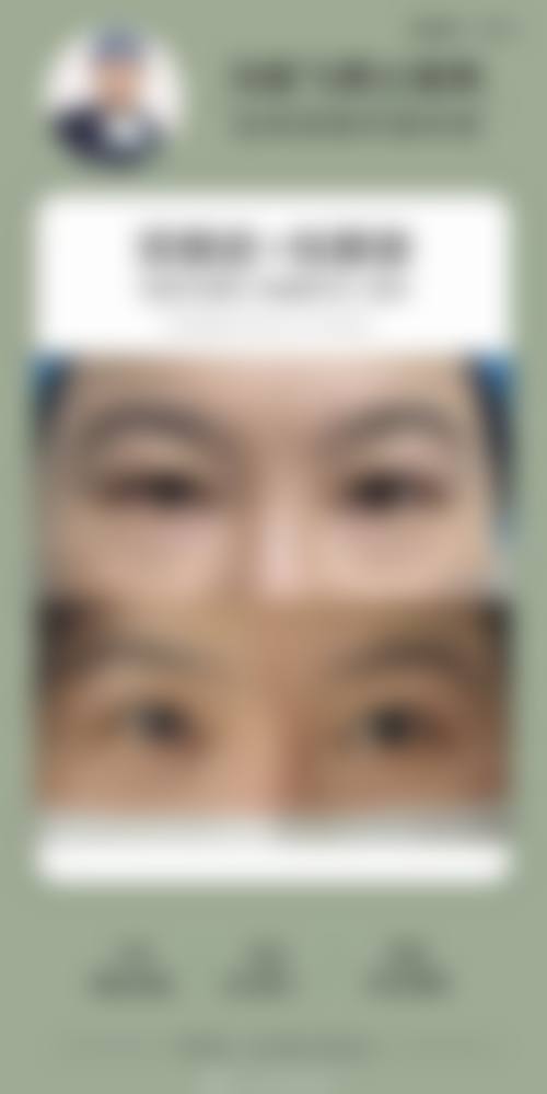 朴尚恩眼部整形水平怎么样可靠吗？