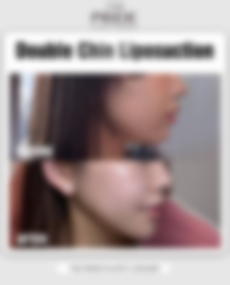 打瘦脸针后，饮食参考表怎么看？