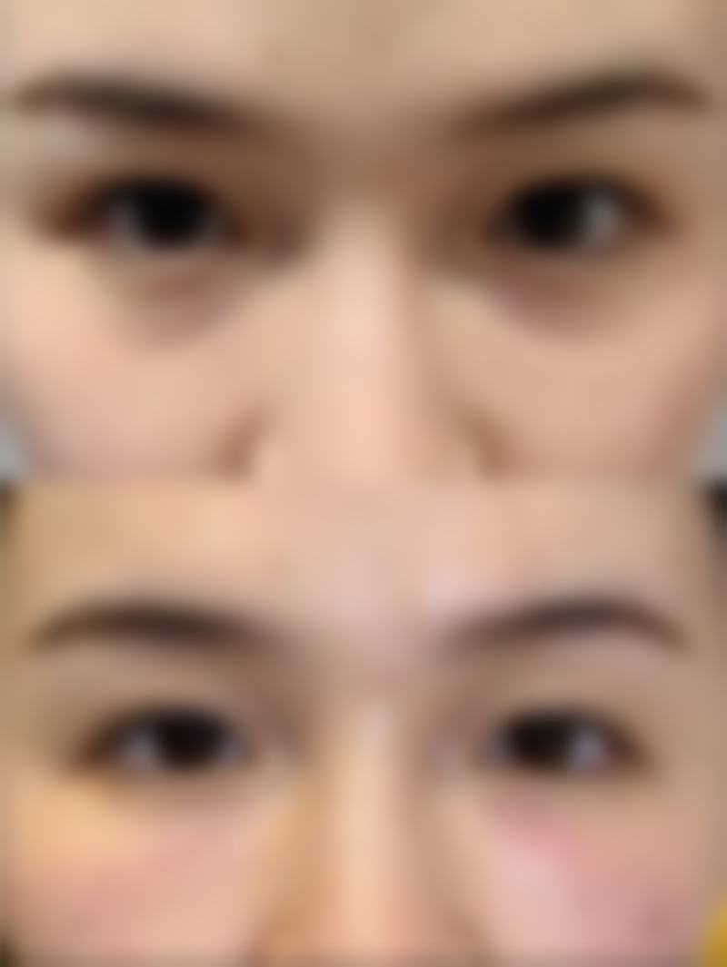 打瘦脸针后，该选哪些软食补充营养？