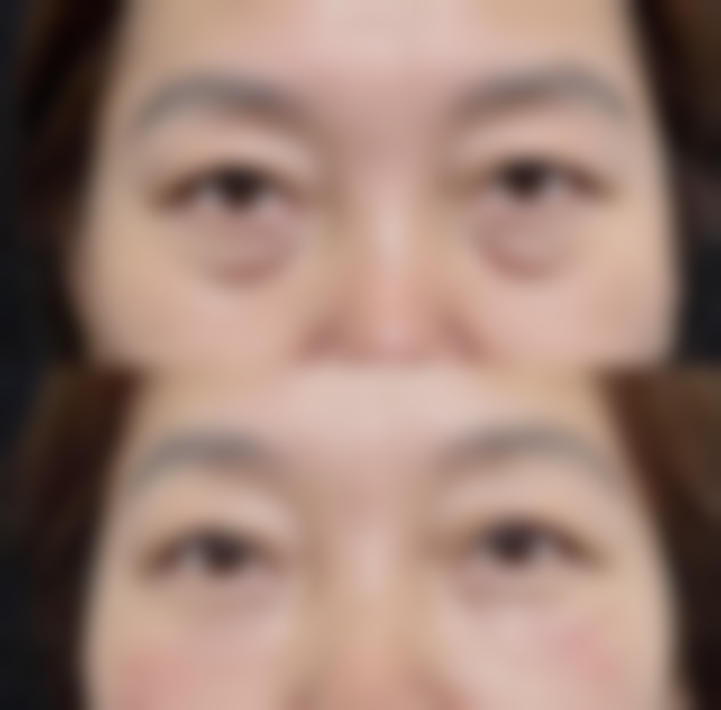 隆鼻后不同阶段的外观变化和应对