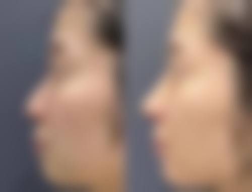 四、福州新世纪整形美容医院实例