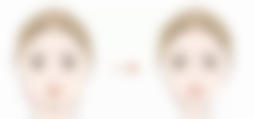 三点定位双眼皮成效能否长久？对比其他双眼皮手术