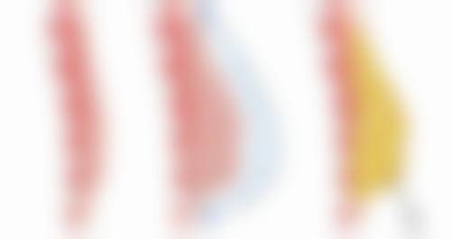 硅胶假体隆胸后能否用手捏?修复中期轻柔触碰有讲究